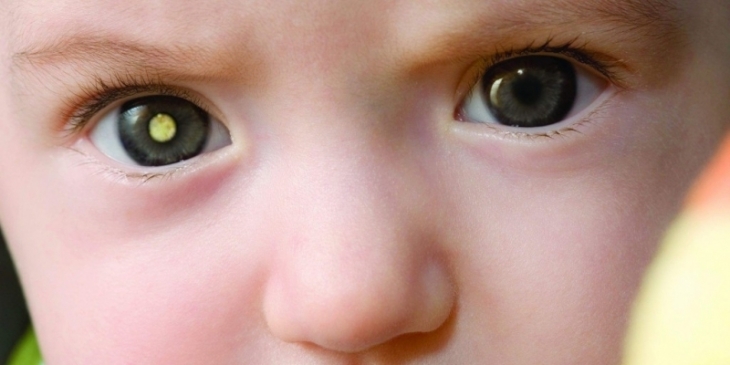 Câncer ocular na infância tem cura de até 100% se diagnosticado precocemente